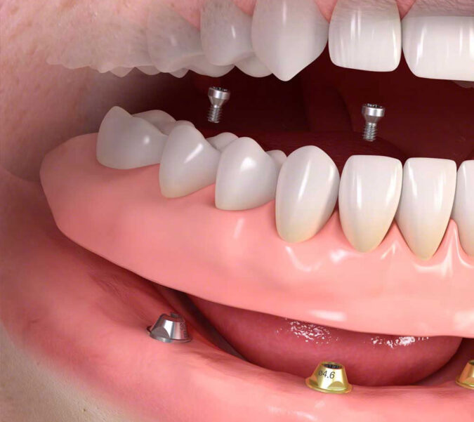Treatment - Shadwell dental
